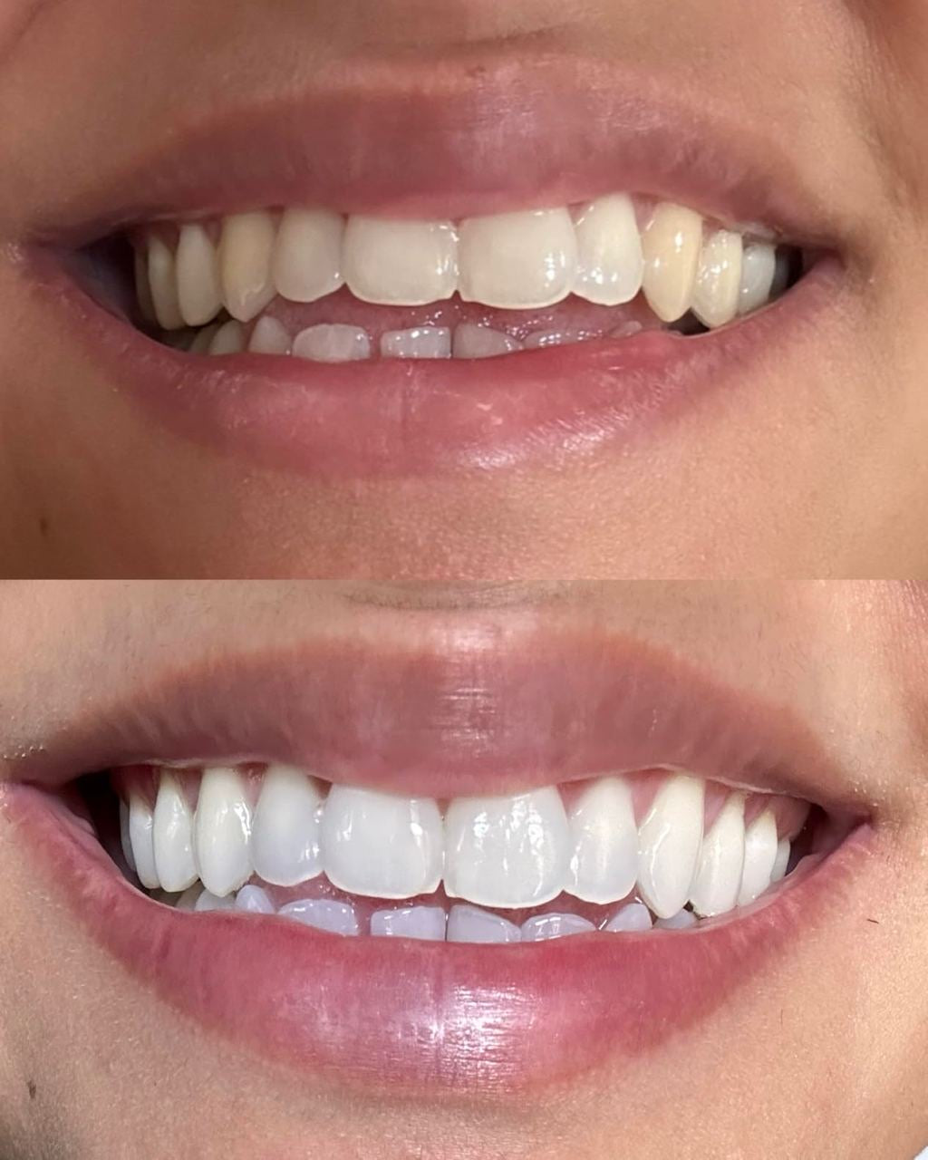 Crest 3D White Strips 1 Heure Express – Blanchiment Dentaire Rapide, 20 Bandes