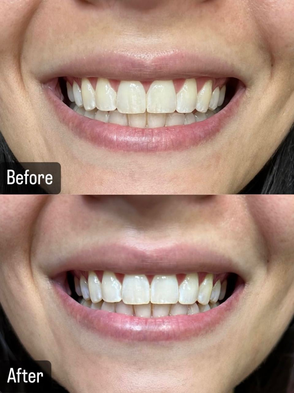 Crest 3D Whitestrips, Professional Effects Plus (LEVEL 23) – Blanchiment Intensif, 40 Bandes