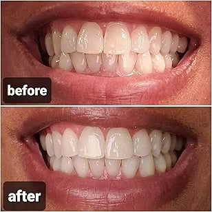 Crest 3D Whitestrips Professionnel - Traitement de 5 Jours