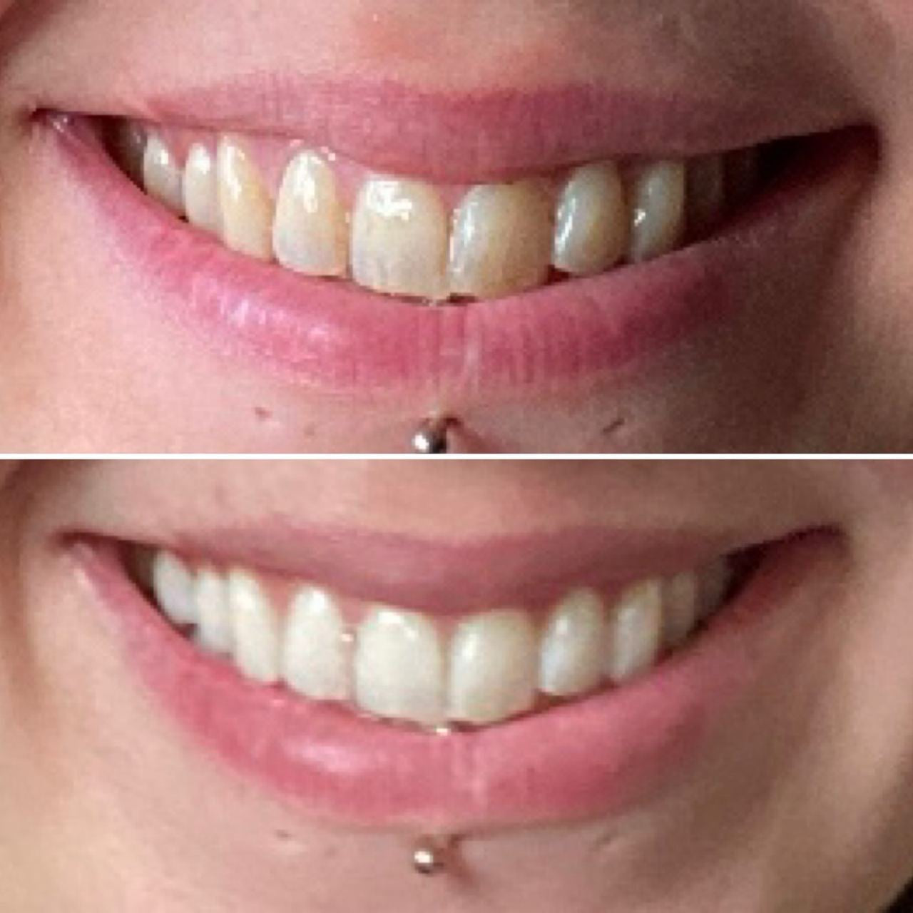 ( NEWS ! ) Crest 3D Whitestrips - Professional White, Traitement professionel